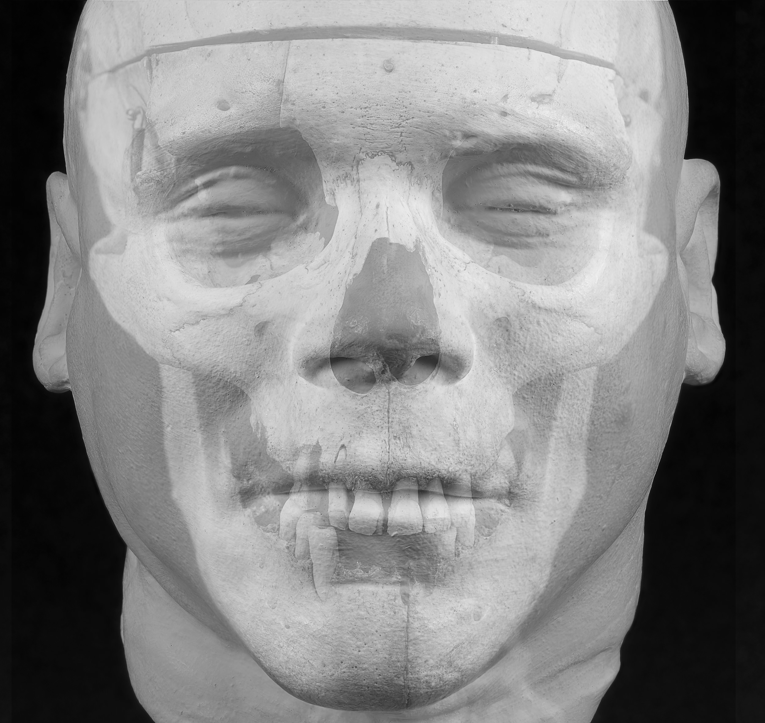 Black and white composite image of the death mask of William Burke, overlayed with the image of his skull, matching up eyes to eye sockets, teeth to mouth etc.
